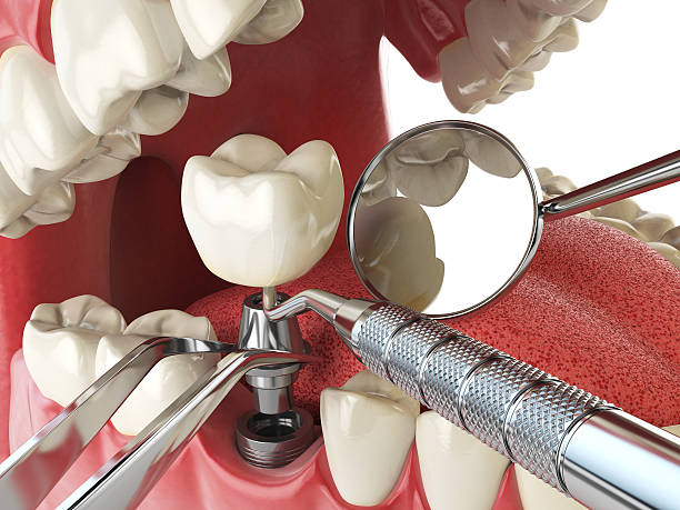 Best Urgent Tooth Repair  in Pioneer, OH
